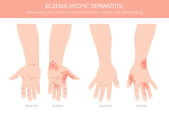 Eczema. Atopic dermatitis. Skin diseases. Medical infographic design. Vector illustration