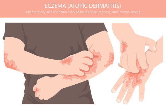 Eczema. Atopic dermatitis. Skin diseases. Medical infographic design. Vector illustration