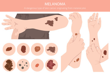 Melanoma. Skin diseases. Medical infographic design. Vector illustration