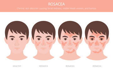 Rosacea. Skin diseases. Medical infographic design. Vector illustration