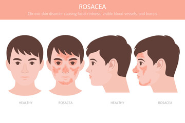 Rosacea. Skin diseases. Medical infographic design. Vector illustration