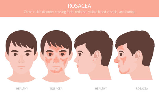 Rosacea. Skin diseases. Medical infographic design. Vector illustration