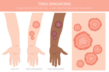 Tinea. Ringworm. Skin diseases. Medical infographic design. Vector illustration