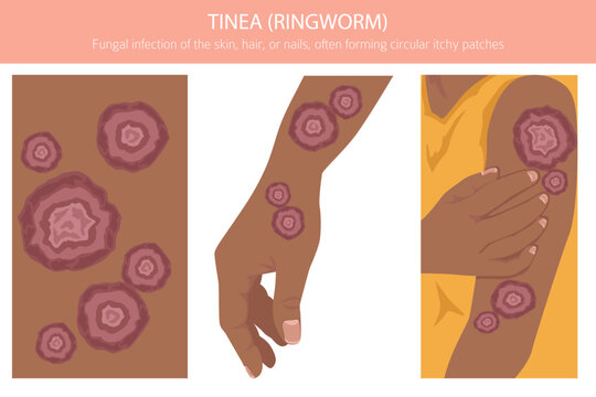 Tinea. Ringworm. Skin diseases. Medical infographic design. Vector illustration