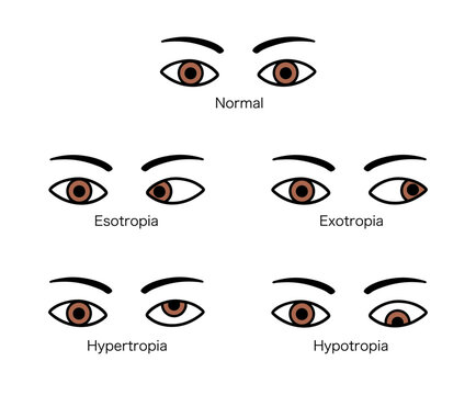 斜視の種類（内斜視、外斜視、上斜視、下斜視）のイラスト
