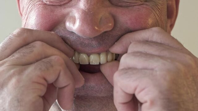 A man removes and installs new dentures on metal crowns and smiles. Telescopic dentures, new technologies. Close-up. Dentistry and prosthetics concept.