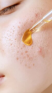 Close up revealing skincare serum gently patting onto problematic skin, targeting acne, rosacea, and scarring while working to restore smooth, healthy complexion