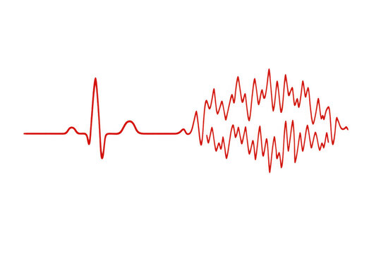 Medical illustration showing a normal sinus rhythm turning into ventricular fibrillation, a life-threatening heart rhythm disorder
