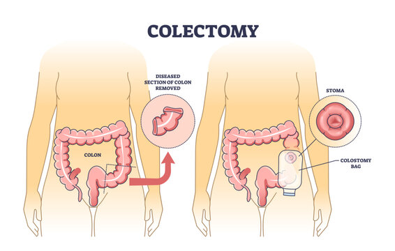 Colectomy diagram shows colon surgery with diseased section removal, stoma, and colostomy bag, transparent background.