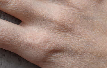 Zbliżenie na sucha skórę, szorstka wysuszona dloń