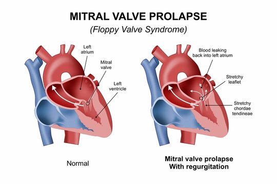 Mitral Valve Prolapse - Floppy Valve Syndrome Heart Illustration