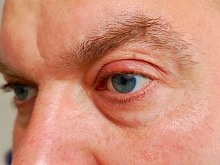 Macro image of a mans irritated eye showing visible stye on the upper eyelid, highlighting common...