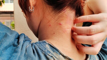 Portrait the fingers scratching the rash hives allergy and inflammation skin, reaction and urticaria, scar and atopic on the neck of the woman, health care and medical concept.