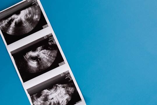 Positive pregnancy test with gynecological ultrasound image, symbolizing pregnancy, family planning, and maternal health. Concept of starting a family, prenatal care, and expecting a baby.
