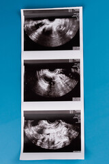 Positive pregnancy test with gynecological ultrasound image, symbolizing pregnancy, family planning, and maternal health. Concept of starting a family, prenatal care, and expecting a baby.