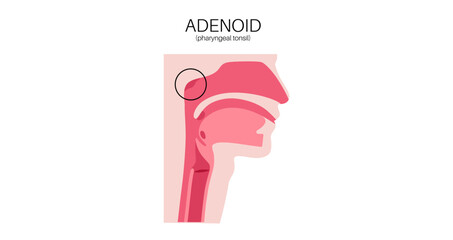 Adenoid medical poster