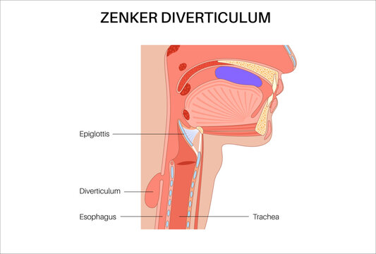 Pharyngoesophageal diverticulum poster