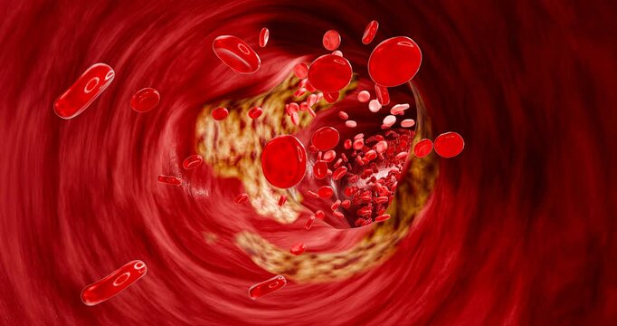 Detailed 3D visualization of vascular blockage caused by unhealthy eating habits, including fast food, sugary drinks, alcohol abuse, and trans fats, contributing to heart attacks and strokes. 3D rende