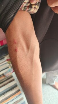 Close-up of a forearm with two red bumps from possible insect bites or allergic skin reaction. Dermatological issue depicted on human skin in natural light.