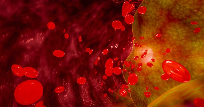 Blocked artery filled with accumulation of fat, cholesterol plaques, blood clots, unhealthy foods, and sugary beverages, illustrating risks of heart disease, stroke, and vascular damage. 3D rendering.