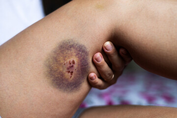 Large bruise and wound on the leg