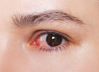 Fototapeta premium Close-up of an eye with conjunctivitis