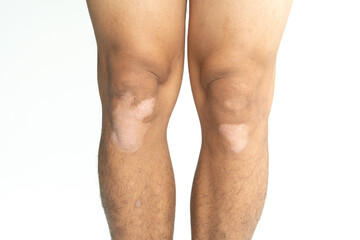 Skin disease around the knee