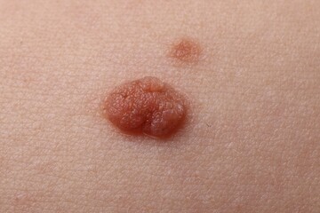 Woman with moles on her body, closeup