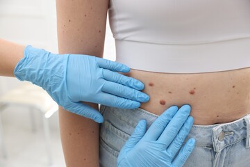 Doctor examining woman's moles in hospital, closeup