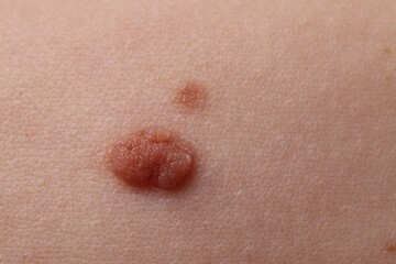 Fototapeta premium Woman with moles on her body, closeup