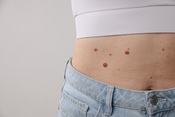 Woman with moles on her body against light background, closeup