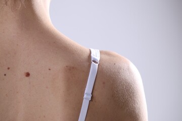 Woman with moles on her body against light background, closeup. Space for text