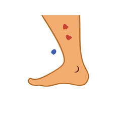 Lower leg with bruises and possible hematoma