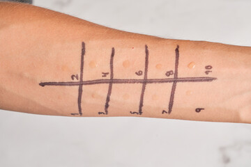 Immunologist Doing Skin Prick Allergy Test on a man's Arm