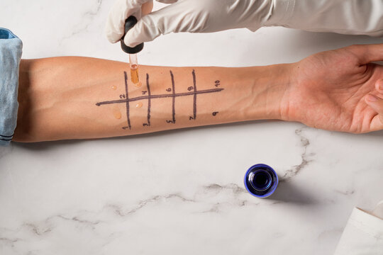 Doctor testing allergy reaction of patient in hospital