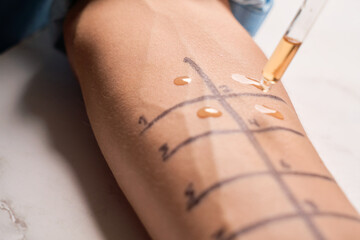Doctor making allergy skin test on patient's hand in clinic