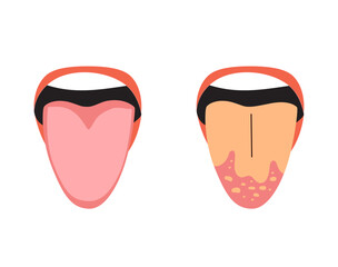 Cartoon comparison between a healthy tongue and one with candidiasis. Useful for health awareness and medical content