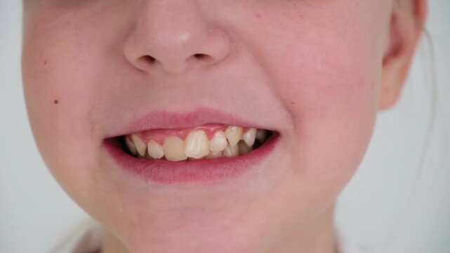 Child has crooked teeth. The concept of crowding of molars.