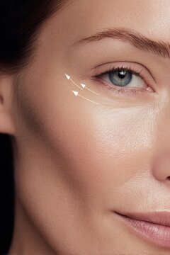wrinkle reduction with nano light under eye treatment