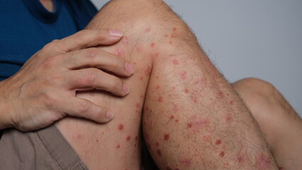 The early signs of redness on the skin that then dries up to become Psoriasis.