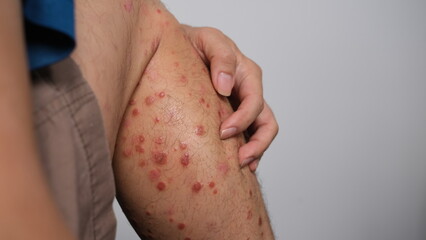 The early signs of redness on the skin that then dries up to become Psoriasis.