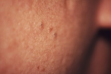 Macro shot of skin texture with blemishes and pores, highlighting imperfections and the need for skincare