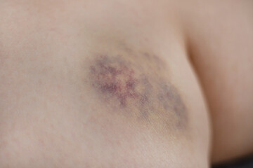 Close-up of healing bruise showing purple and yellow colors. bruise on inner thigh near knee