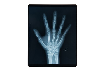 X-ray of a Human Hand Showing Bone Structure