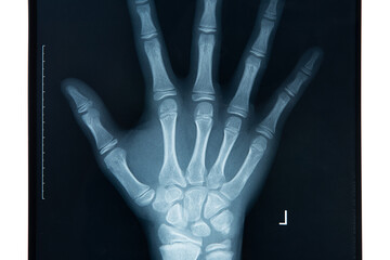 X-ray of a Human Hand Showing Bone Structure