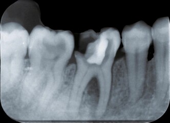 Periapical x-ray showing  caries dentis 
