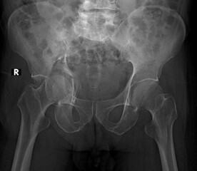 X-ray of the pelvis of a patient with a fracture of the acetabulum 