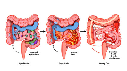 intestinal health symbiosis dysbiosis leaky gut