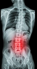 Medical X-Ray Scan of Human Spine, Backbone Anatomy and Lumbar Pain