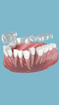 Invisalign braces or invisible retainer make bite correction. 3D animation
